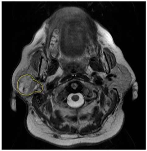 prada gland cancer|parotid gland cancer imaging.